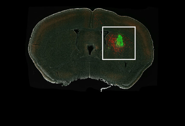 1350glioma 850